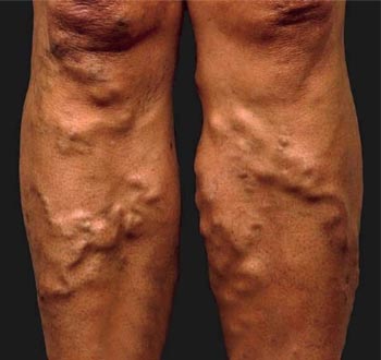 Varicose Vein Ayurvedic Treatment