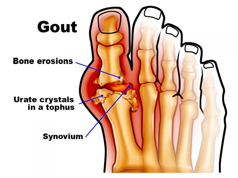 Vatarakta Chikitsa – Treatment for Gouty Arthritis in Ayurveda