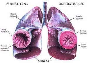 Asthma Ayurvedic Home Remedies