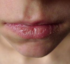 Cracked lips Ayurvedic Home Remedies