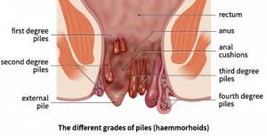 home-remedies-for-haemorrhoid-piles