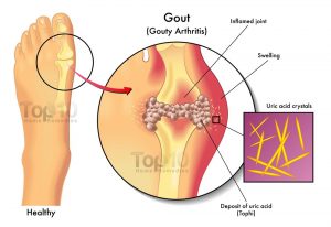 gruhadhoomadi-choorna-in-gouty-arthritis