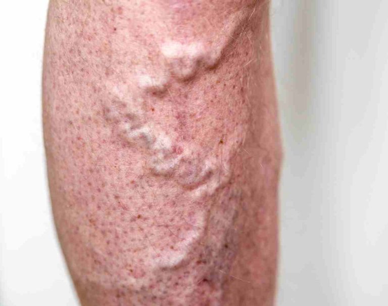 Varicose Veins Treatment in Ayurveda